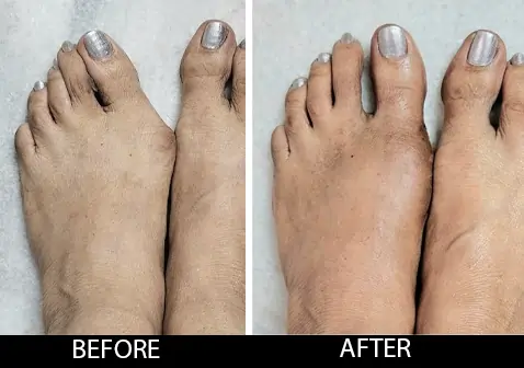 Plantar Fasciitis Before After