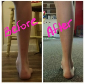 Hammer Toe Before After