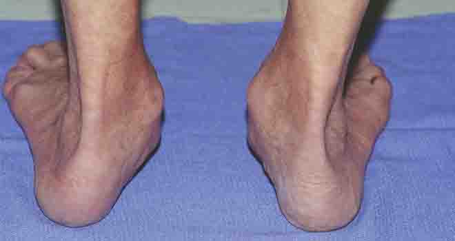 Flat Foot Reconstruction