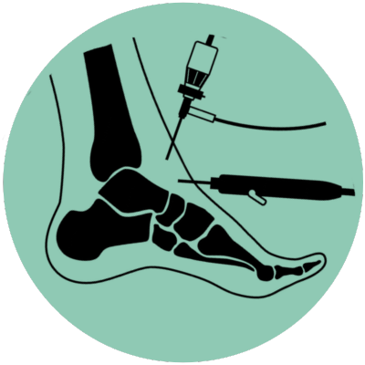 Ankle Arthroscopy