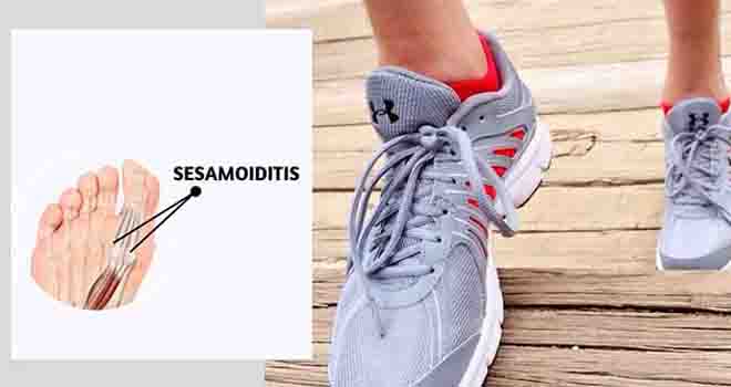 Sesamoiditis Treatment